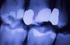 X-ray of a filled tooth
