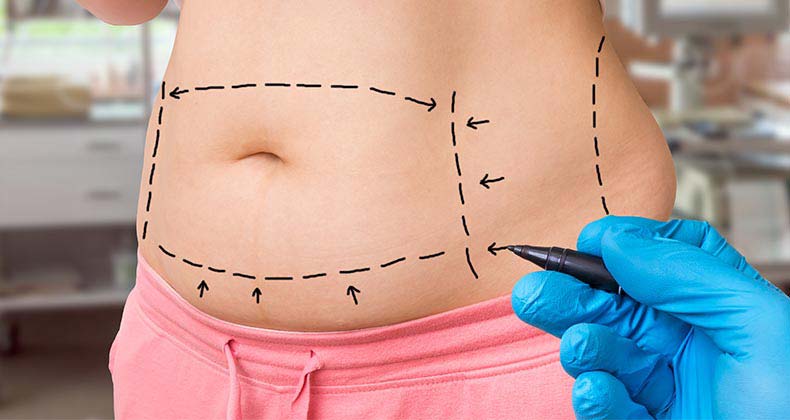 tummy tuck cost illinois