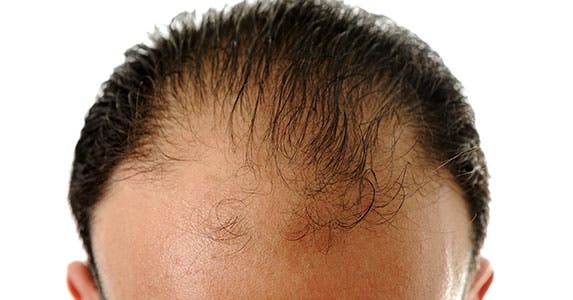 Hair today, gone tomorrow © Zurijeta/Shutterstock.com